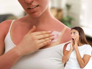 donna che spalma crema su scottatura solare e un'altra sorpresa
